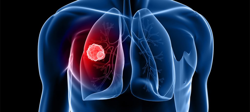 Computer generated image showing cancer in a person's lung