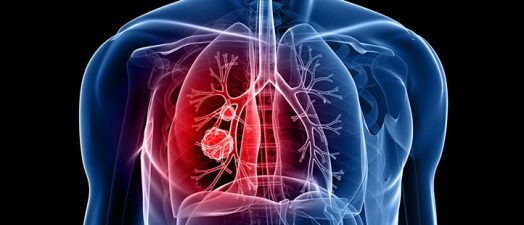Lung cancer graphic