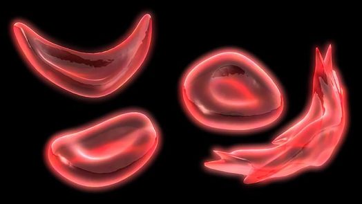 sickle cell image