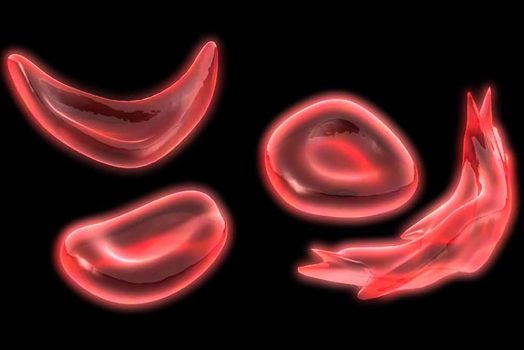 sickle cell image