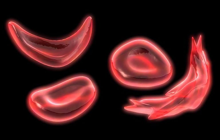 sickle cell image