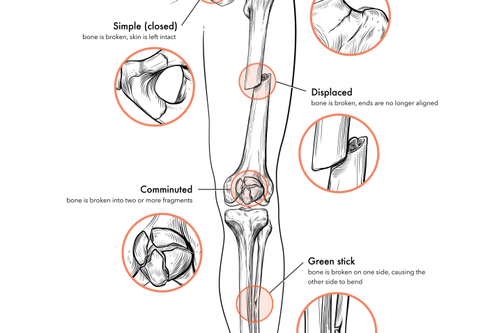 illustration of bone fractures