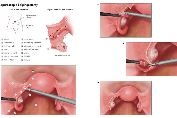illustration of Laparoscopic Salpingectomy