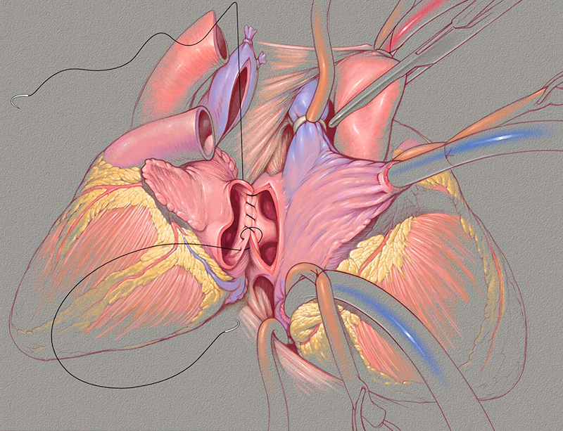 Rendering of a heart transplant.