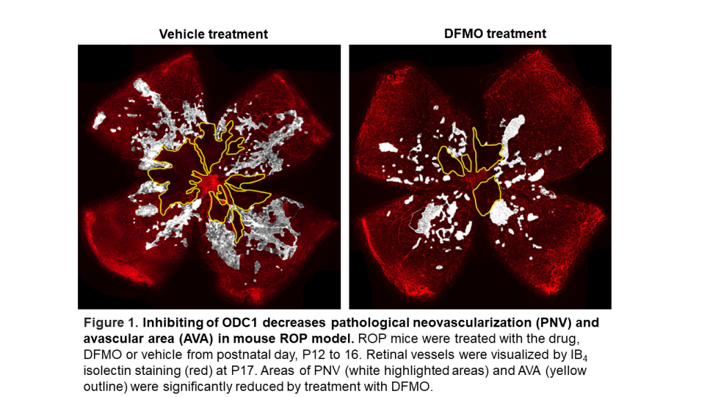 side-by-side comparison of cells under a microscope; text states: Vehicle treatment, DFMO treatment; caption states: Figure 1. Inhibiting of ODC1 decreases pathological neovascularization (PNV) and avascular area (AVA) in mouse ROP model. ROP mice were treated with the drug DFMO or vehicle from postnatal day, P12 to 16. Retinal vessels were visualized by IB4 isolecting staining (red) at P17. Areas of PNV (white highlighted areas) and AVA (yellow outline) were significantly reduced by treatment with DFMO.