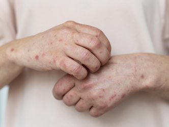 A person with measles on their arms