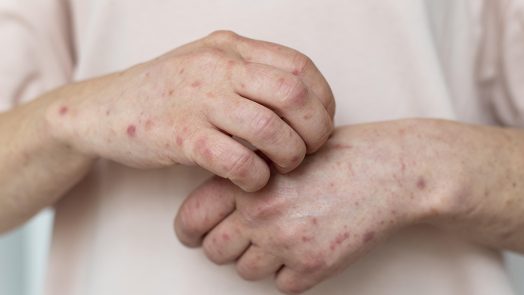 A person with measles on their arms