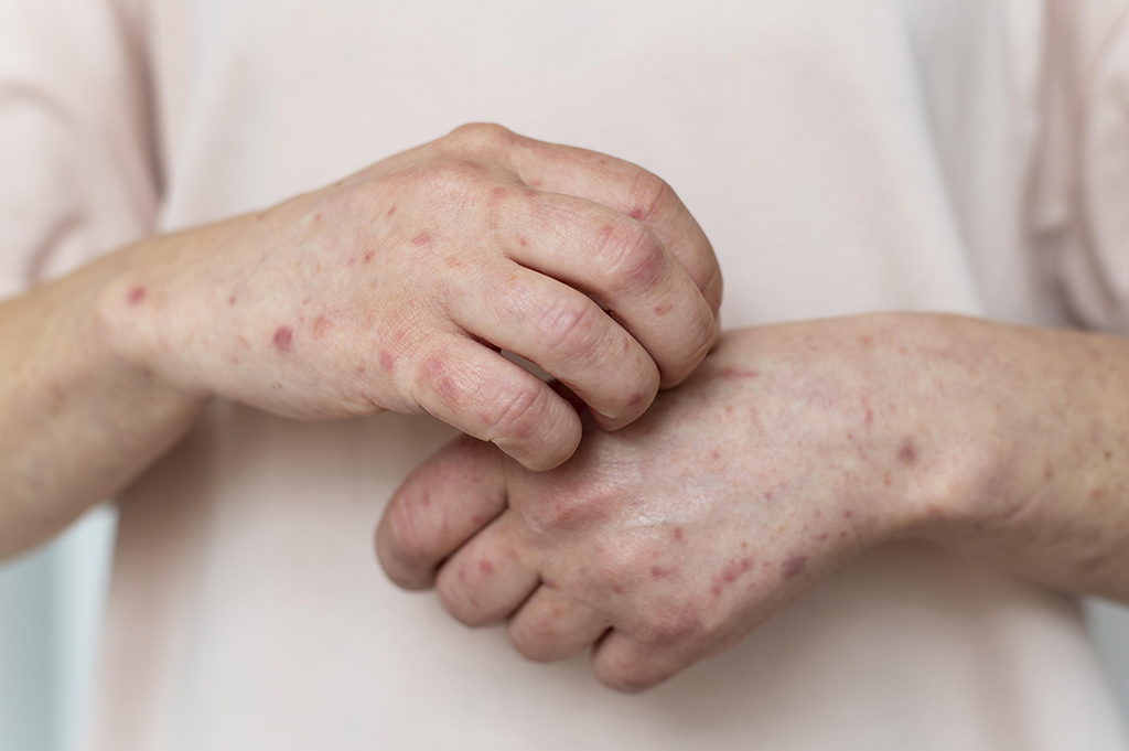 A person with measles on their arms