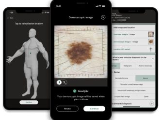 In this photo, you see multiple iPhones with screens that show different images. One screen shows a possible skin cancer lesion. Another screen shows data about that skin cancer lesion. The third screen shows where on the body that lesion is located.