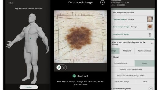 In this photo, you see multiple iPhones with screens that show different images. One screen shows a possible skin cancer lesion. Another screen shows data about that skin cancer lesion. The third screen shows where on the body that lesion is located.