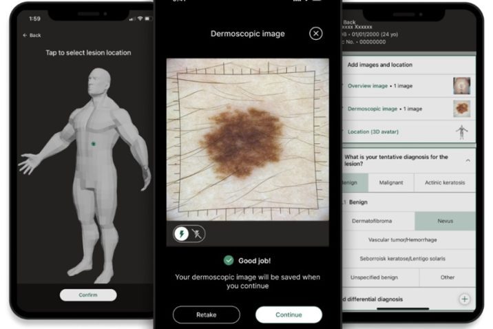 In this photo, you see multiple iPhones with screens that show different images. One screen shows a possible skin cancer lesion. Another screen shows data about that skin cancer lesion. The third screen shows where on the body that lesion is located.