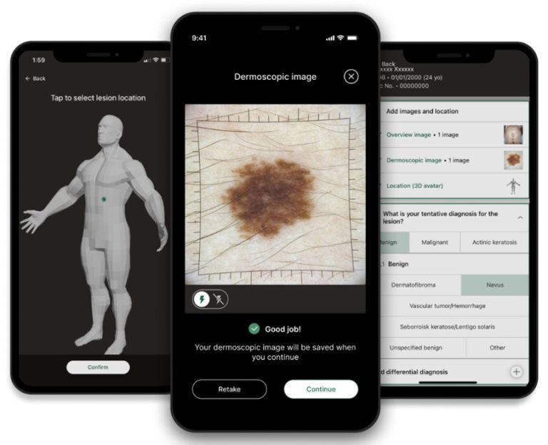 In this photo, you see multiple iPhones with screens that show different images. One screen shows a possible skin cancer lesion. Another screen shows data about that skin cancer lesion. The third screen shows where on the body that lesion is located.