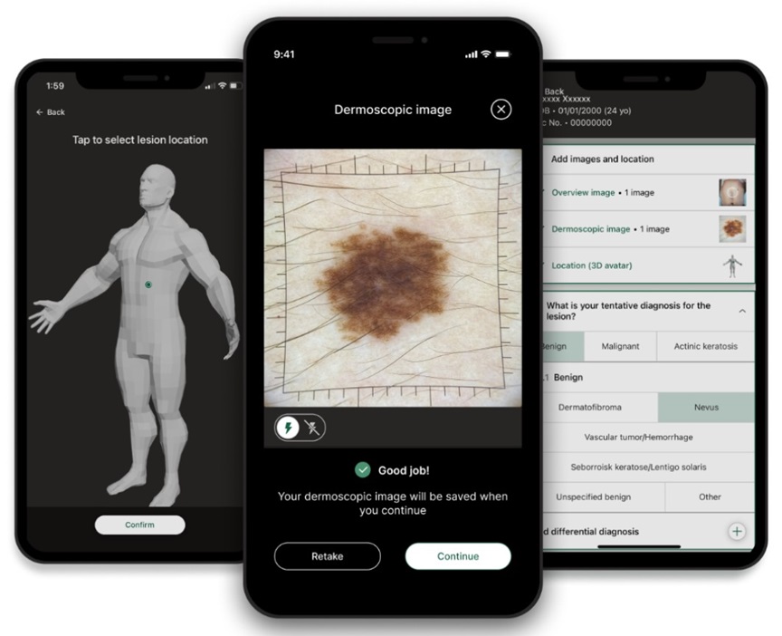 In this photo, you see multiple iPhones with screens that show different images. One screen shows a possible skin cancer lesion. Another screen shows data about that skin cancer lesion. The third screen shows where on the body that lesion is located.